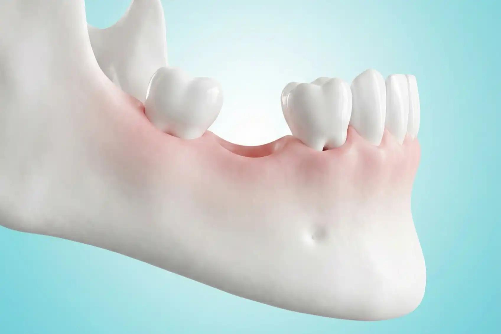 Perdeu um Dente e Não Repôs? 5 Consequências Graves (Além da Estética)
