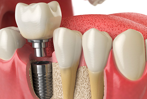 Perguntas e respostas sobre implantes dentários