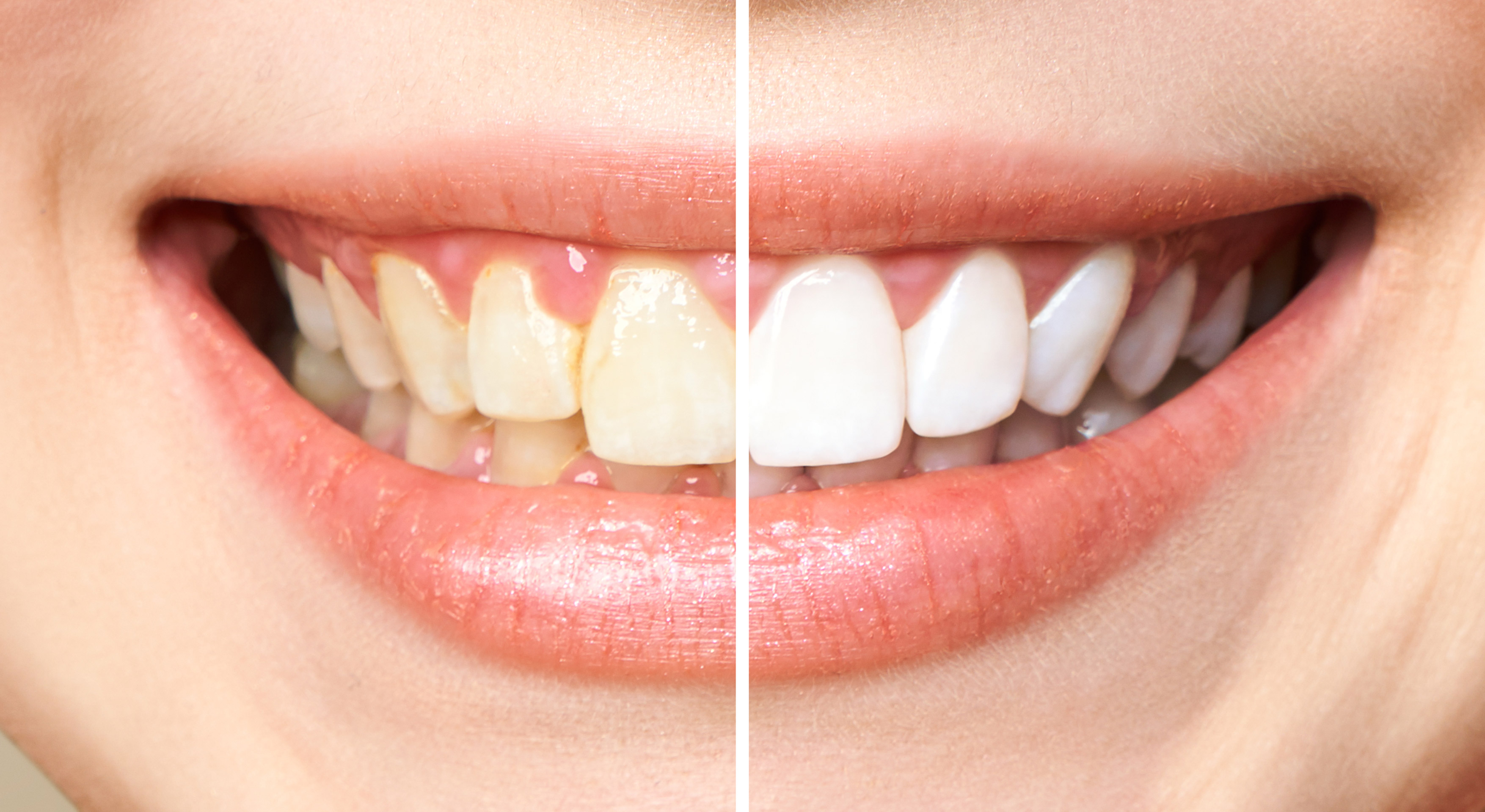 Clareamento Dentário: como fazer com segurança?