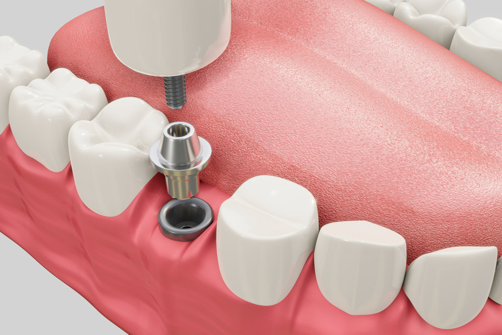 Pós-operatório de implante dentário
