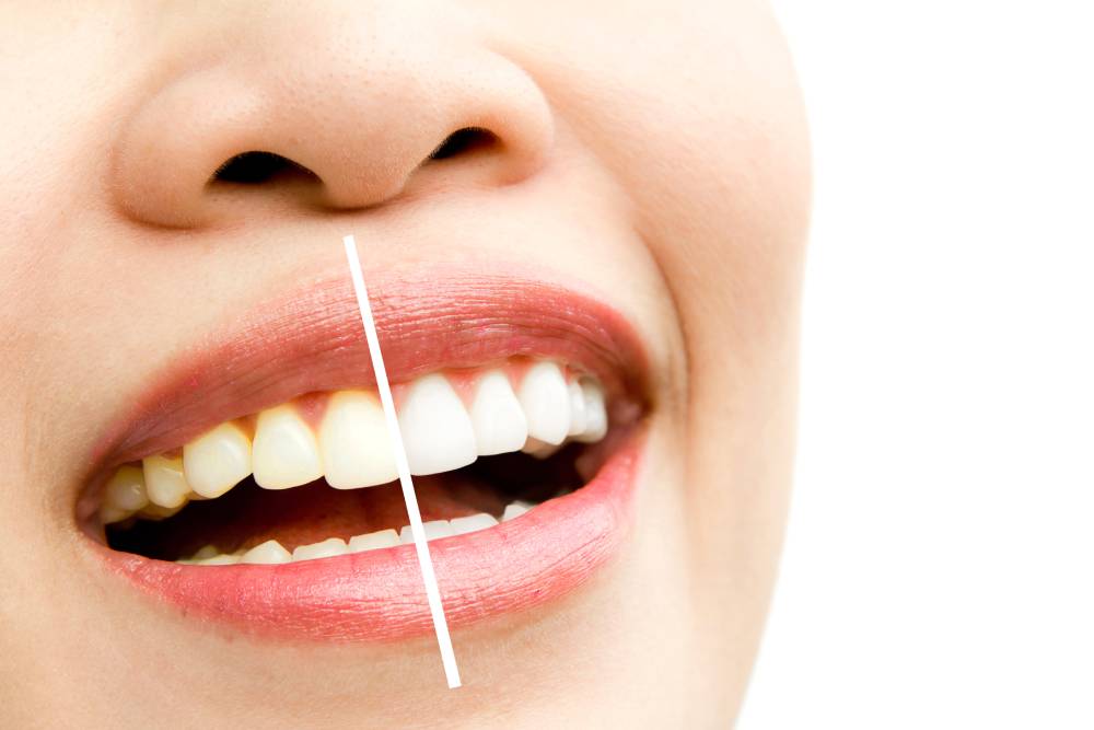 5 cuidados importantes após um clareamento dental