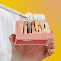 Implantes Dentários | IMPLANTODONTIA